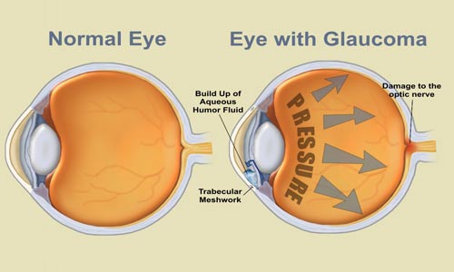 مقارنة بين عين سليمة وعين مصابة بمرض الماء الأزرق "الغلوكوما"