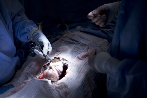 US-HEALTHCARE-TRANSPLANT-SURGERY